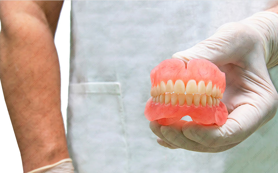 Clean All-on-4 Dental Implants