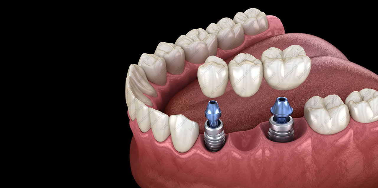 Overdenture Abutments