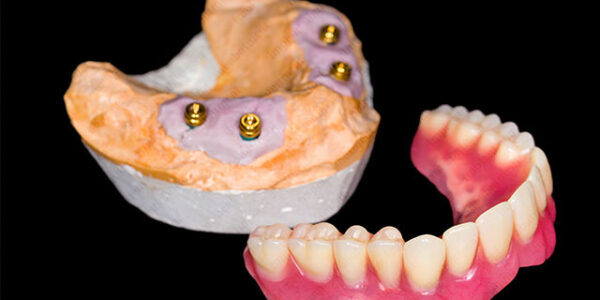 The Lowdown on Overdenture Systems and Their Abutments