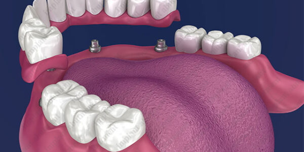 The Case for Partial Overdentures